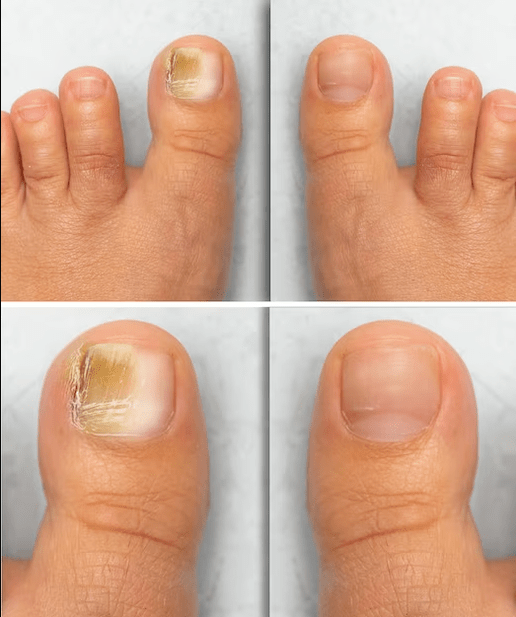 Foot Mushrooms - Before and After Treatment with Function Cream