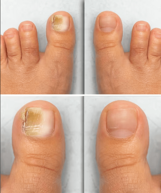 Foot fungus - before and after treatment with Fungent cream