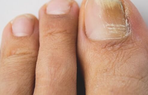 Nail mushroom