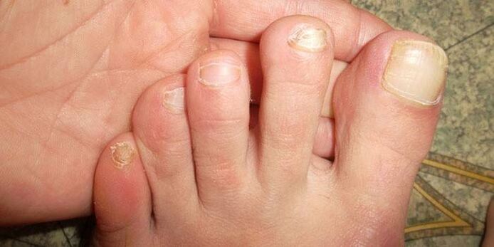 Update the nail after an injury