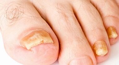 How to treat nail mushrooms
