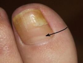 How to recognize the presence of a nail fungus on the thumb of the leg