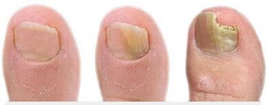 Steps of the development of fungi on the nails