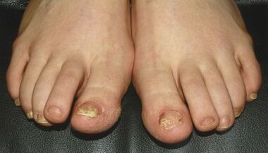 Signs and symptoms of fungus on the nails