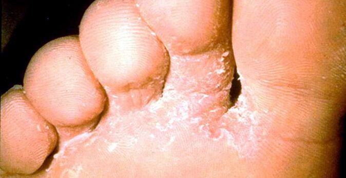 Lesion of the fungus of the skin between the toes