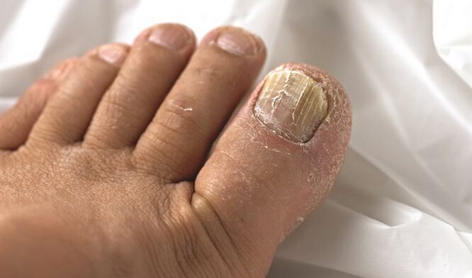 Spread the lesion of mycosis on the plate