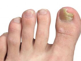 Yellow spots on the nails of mushroom signs
