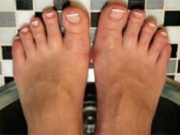 fungus on the nails and the skin of the legs