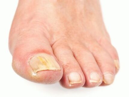 damage caused by nail fungus