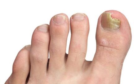 fungus on the nail of the big toe