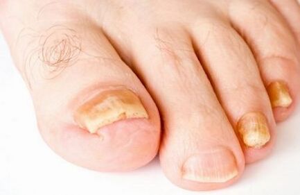 yellowing of nails due to fungus
