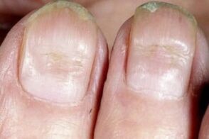 symptoms of fungus on nails