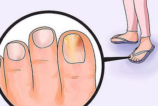 fungus on nails