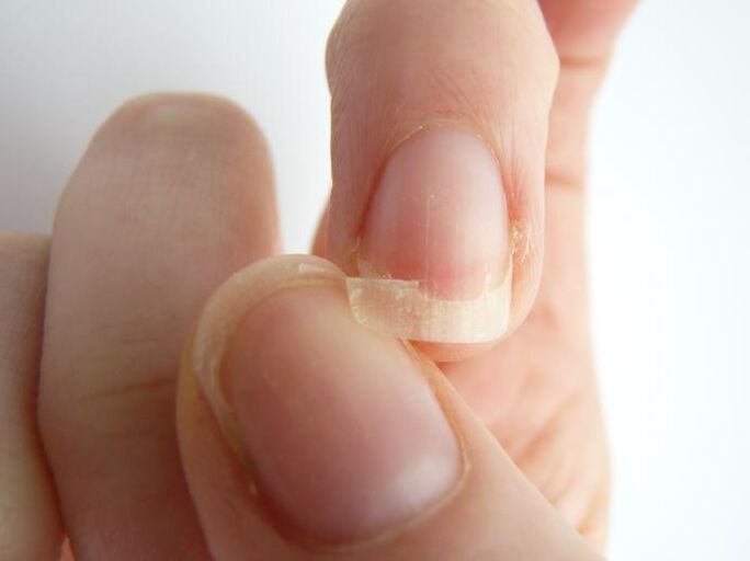 nail peeling due to fungus