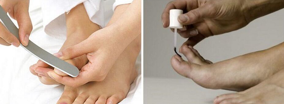treatment of fungus on nails with varnish